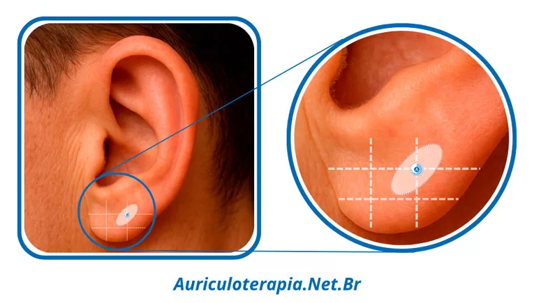 Ponto Face localizado no Lóbulo da orelha, utilizado na auriculoterapia para tratar problemas da área da face/bochecha.