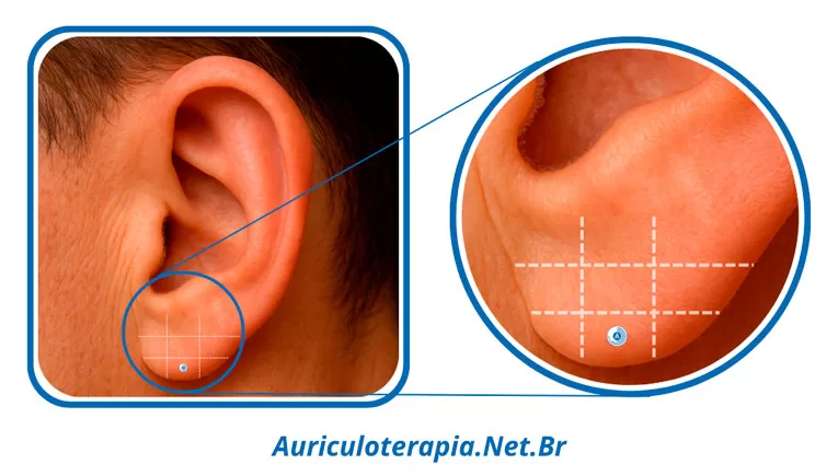 Ponto da Amígdala localizado no Lóbulo da orelha, utilizado na auriculoterapia para tratar dores de garganta, amigdalite, faringite e inflamações da garganta.