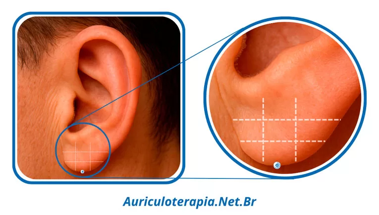 Ponto Hélix 6 localizado no Lóbulo da orelha, utilizado na auriculoterapia para tratar condições inflamatórias.
