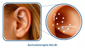 Ponto Articulação Coxofemoral localizado na Fossa Triangular da orelha, utilizado na auriculoterapia para o tratamento das afecções desta região.