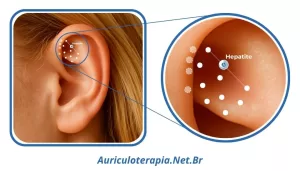 Ponto Hepatite localizado na Fossa Triangular da orelha, utilizado na auriculoterapia para tratamento de afecções hepáticas.