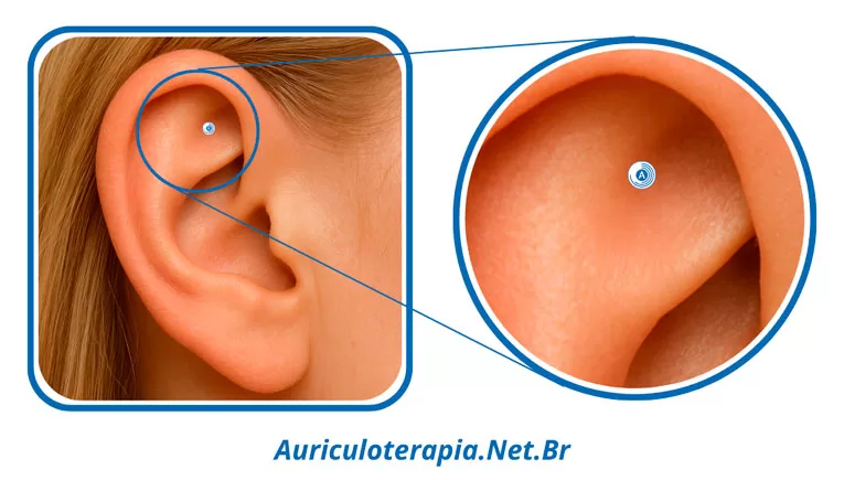 Ponto Hepatite localizado na Fossa Triangular da orelha, utilizado na auriculoterapia para tratamento de afecções hepáticas.