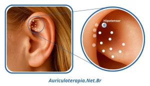 Ponto Hipotensoir localizado na Fossa Triangular da orelha, utilizado na auriculoterapia para o tratamento da hipertensão arterial sistêmica.