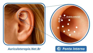 Ponto Ovário Inferior localizado na Fossa Triangular da orelha, utilizado na auriculoterapia para o tratamento de problemas menstruais.